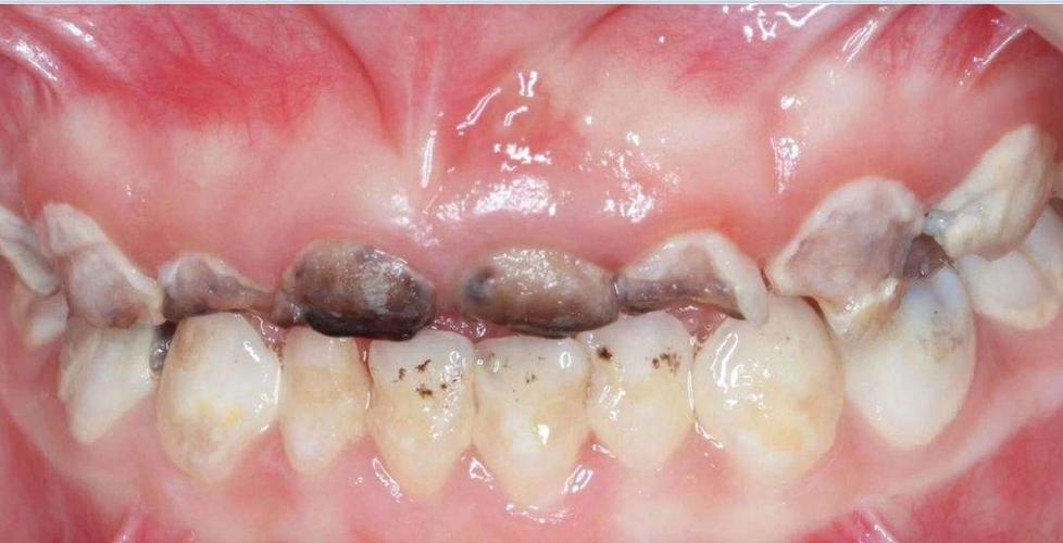 儿童脱矿的牙齿图片 儿童脱矿的牙齿能恢复吗?-图片大观-奇异网