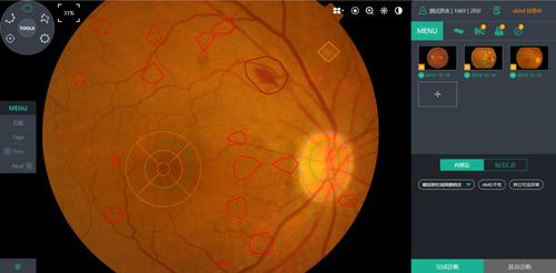 用人工智能更高效分配医疗资源致远慧图发力眼科医疗领域