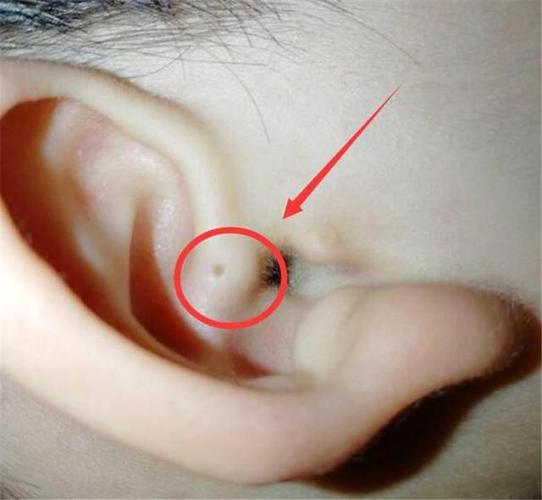 其实这个小洞并不是幸运的象征,而是一种先天畸形,学名叫耳前瘘管.