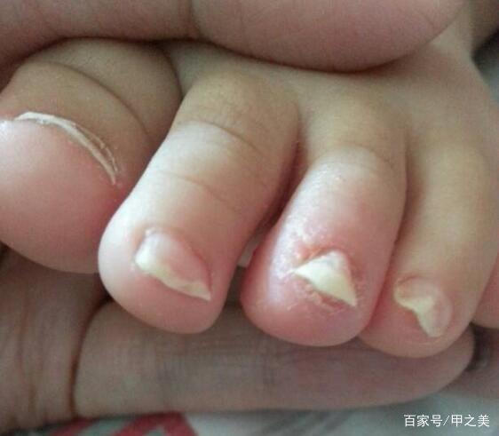 宝宝指甲变色警惕感染灰指甲