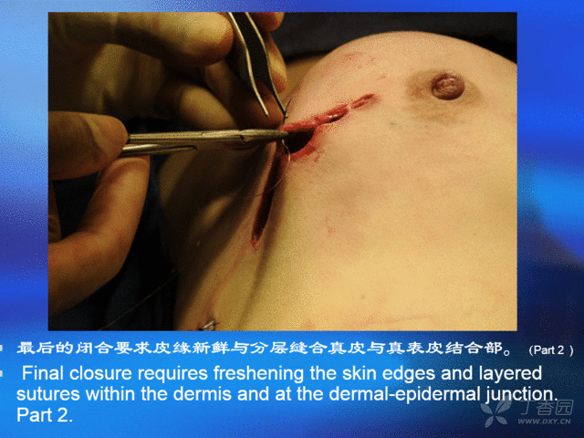 组织扩张器快捷式乳房重建首选手术