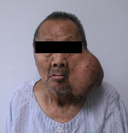 83岁老爷爷脸上长"足球样"巨瘤,20年未割舍,今被成功摘除