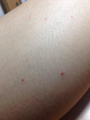 腿上皮肤突然发现长了好几个这种小红点,请问是怎么回事?