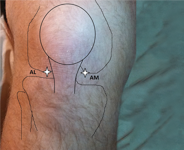 膝关节玻璃酸钠注射治疗轻中重度膝关节炎获多项国际权威指南推荐疗效