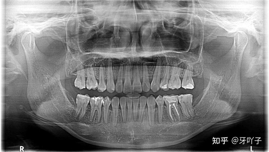 由正畸医师进行临床资料的采集,拍口腔全景x光片,还有面部,牙齿和口腔