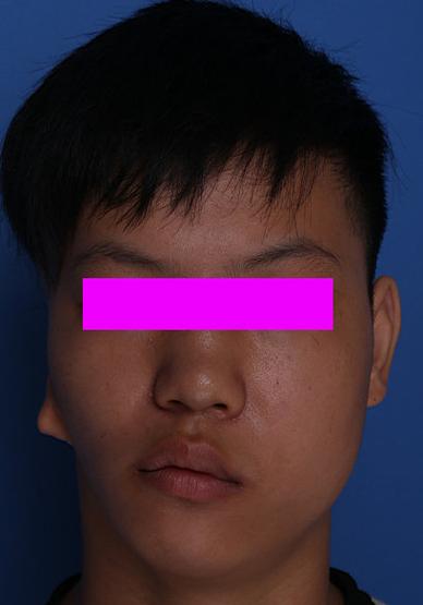有的病人会合并两侧脸发育的不对称,即俗称的"大小脸".