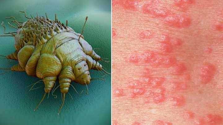 疥疮被世界卫生组织列为传播疾病之一,它由于人体感染了疥虫(人疥螨)