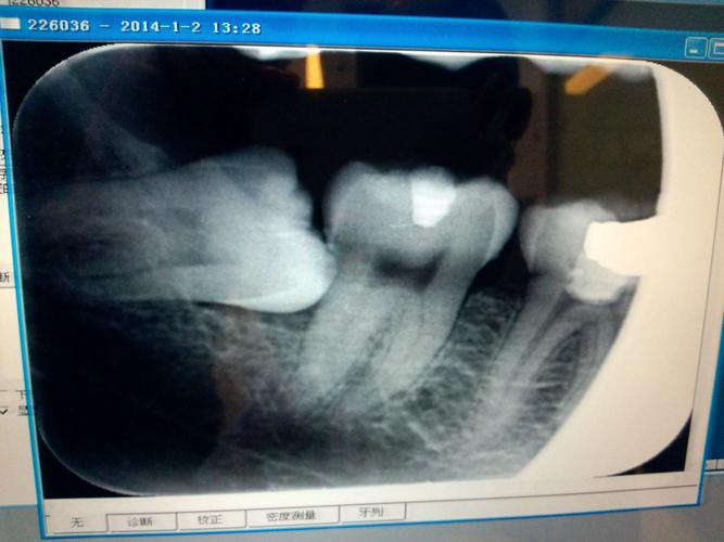 请教赵凯,补牙后的疑似牙髓炎问题.