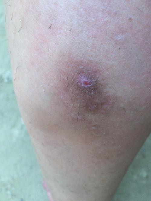 我左小腿上在一年前突然长了一块褐色的斑不疼不痒但是很难看