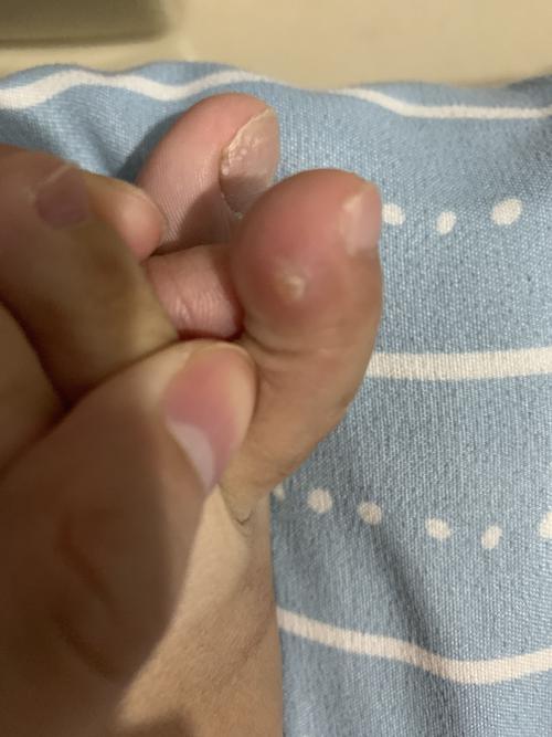 左脚二拇指左侧长了个类似疙瘩的东西,导致二拇指头比正常要肿一点