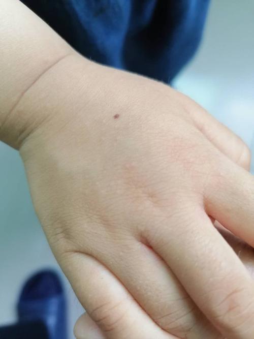 问:3岁孩子,最近四五天手上起了白色的痘痘,不是水泡的感觉,也不痒