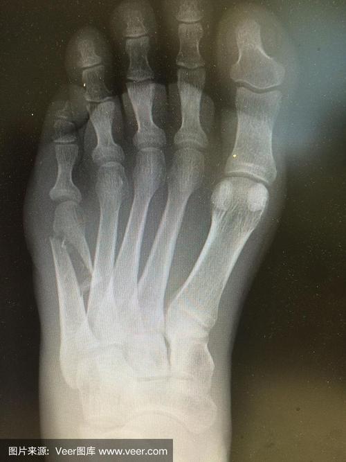 足部骨折x线照片,ap视图