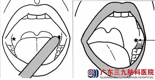(图示)用手指或压舌板轻轻刺激k点,以促进张口及诱发吞咽反射