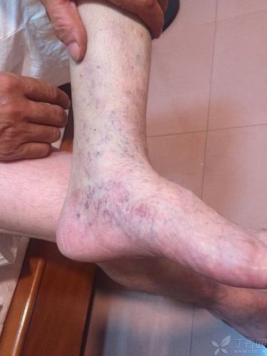 53岁,近一个半月来发现双小腿1/3以下皮肤满布毛细血管扩张,无压痛,反