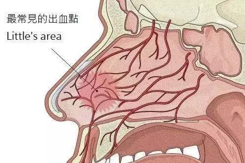 一个鼻腔最容易出血的地方,它叫利特尔区(little area),又称黎氏区,为