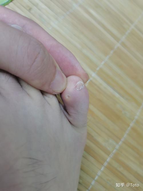 我的小脚趾头一直磨旁边的脚趾,磨了一个茧子,很痛,是我鞋子的问题吗