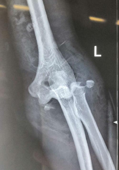 术前x片及ct可见肘关节后脱位,尺骨冠突骨折,桡骨小头骨折.