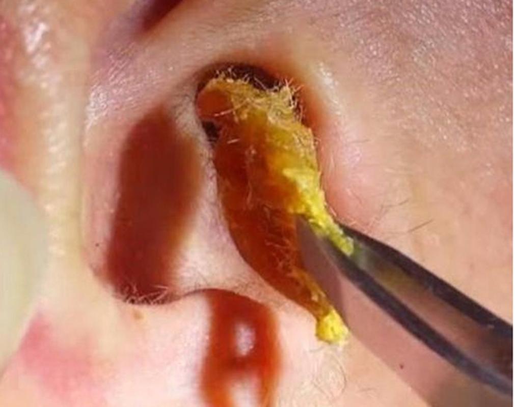 耳屎是耳内耵聍腺分泌的淡黄色粘稠状物质,该物质和皮肤脱落掉下来的