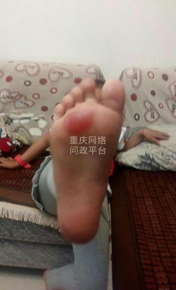 重庆小学老师罚学生赤脚跑操场有孩子脚底磨出泡