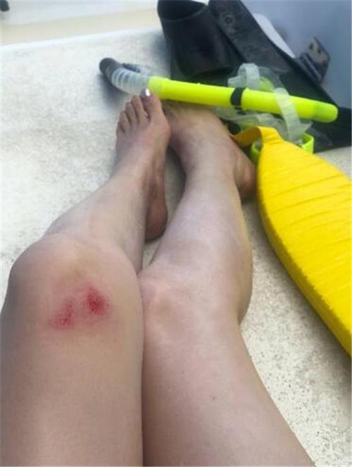 殷桃微博晒受伤照片让网友引她为戒受伤了一定要去医院