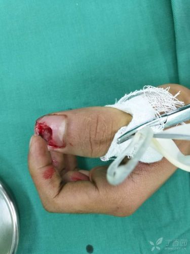 拇指甲床移植 - 修复重建和烧伤整形讨论版 -丁香园论坛