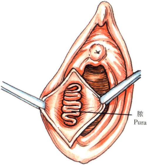 前庭大腺脓肿切开引流术