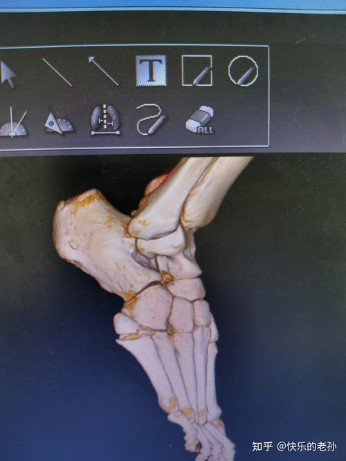 第五跖骨基底部骨折康复记录1保守治疗阶段
