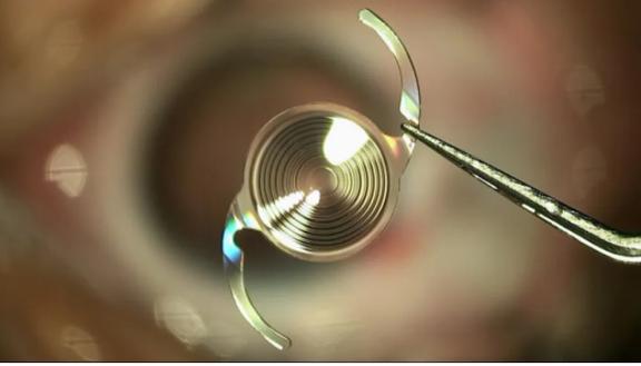 爱尔眼科引进创新人工晶体