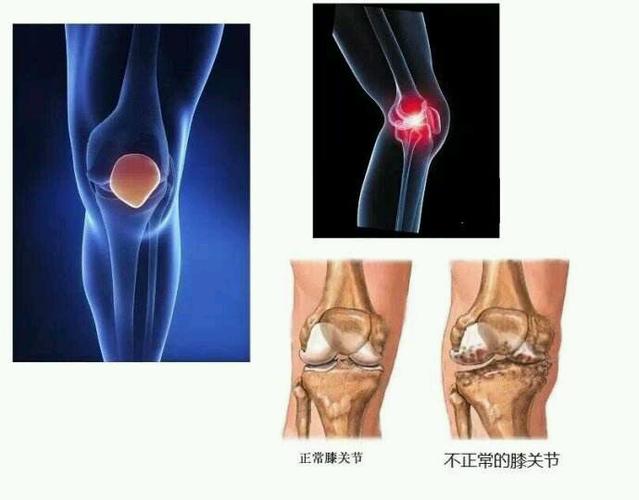 常见为膝盖滑膜炎.