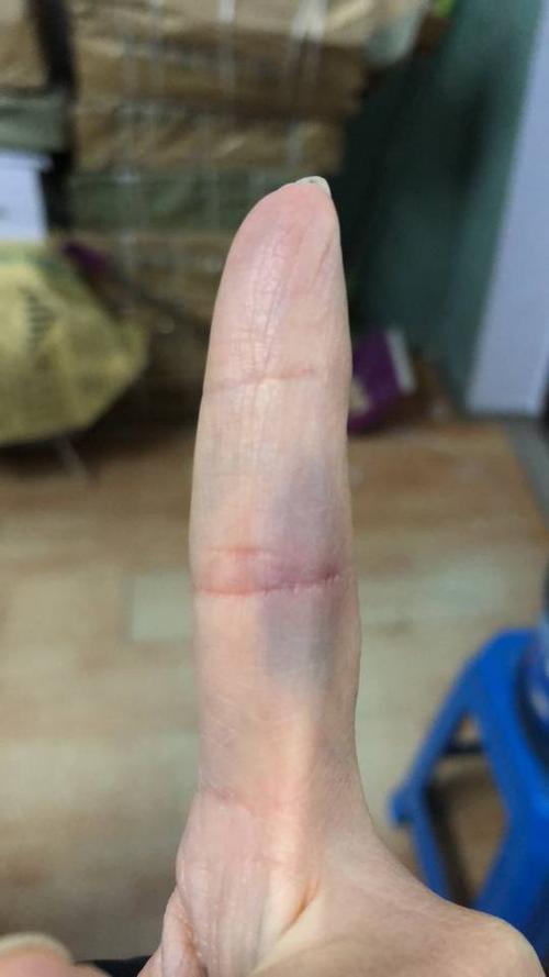 20 …没有外伤,没有挤压,今天突然发现手指这个部位发青,关节纹部位