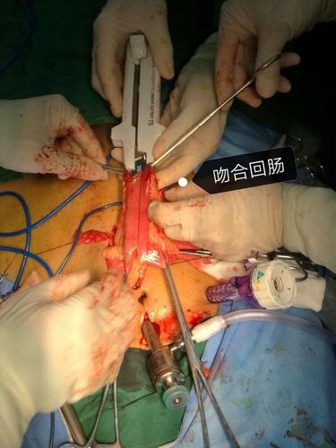 海南省中医院泌尿外科(外二科)首例腹腔镜膀胱根治性切除 回肠原位膀