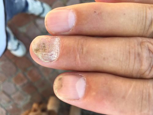 手指甲变形,这是一种什么病?