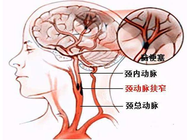 颈动脉位于喉结两侧,左右各一根,颈动脉位置在人群中有一定的个体差异