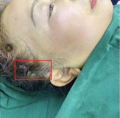 王教授做小切口拉皮手术的切口位置是在耳上方发际线的部位做1.