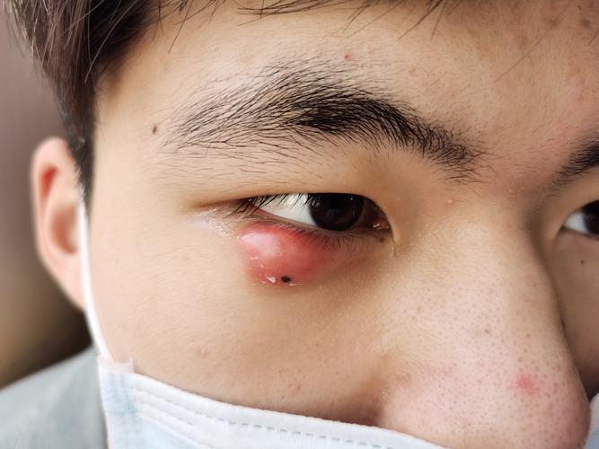 睑腺炎俗称麦粒肿中医名针眼的个人经验治疗