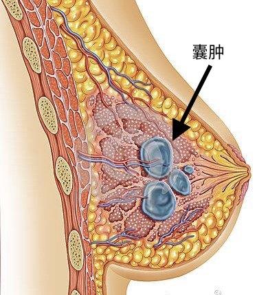 乳腺体检时,"囊肿"是最常见的异常.