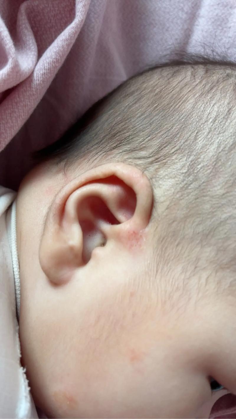 宝宝耳部湿疹是一种特应性皮炎,爱这个部位 - 抖音