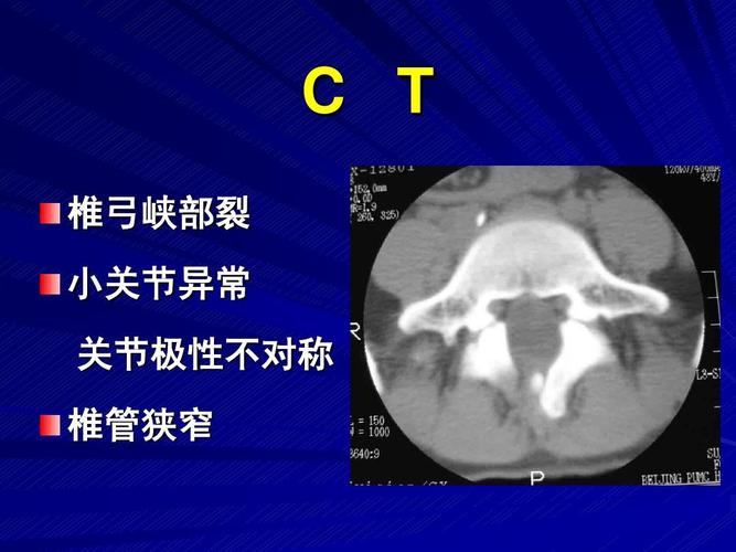 c t 椎弓峡部裂 小关节异常 关节极性不对称 椎管狭窄