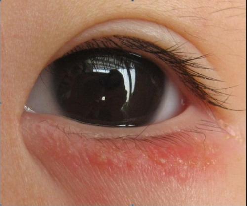 求助4个多月的婴儿左眼左下眼皮红肿