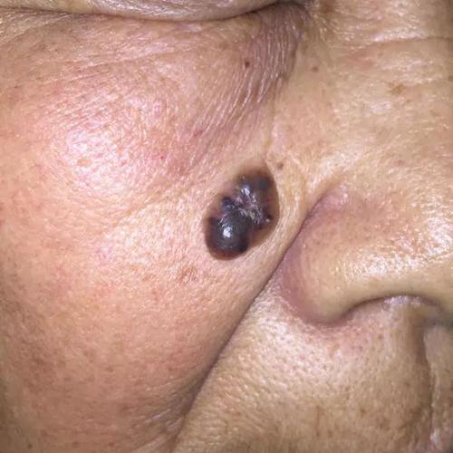 56岁脸上开始长"黑斑",检查发现不是老人斑而是