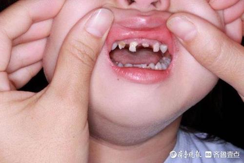4岁娃满口18颗乳牙龋坏,滨州市人民医院实施全麻下一次性治疗