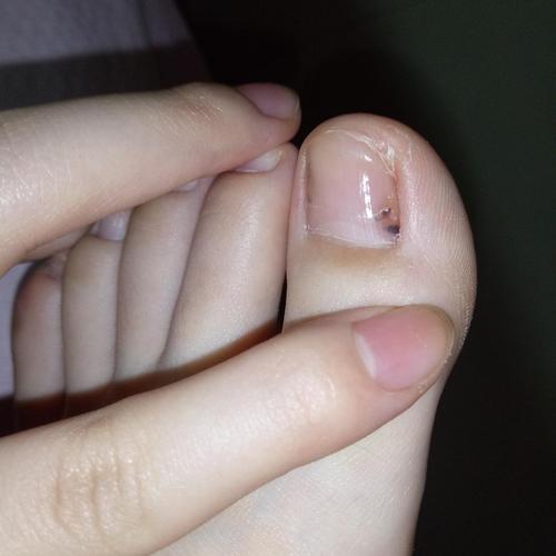(更新图片)两个大脚趾头指甲里都有黑块