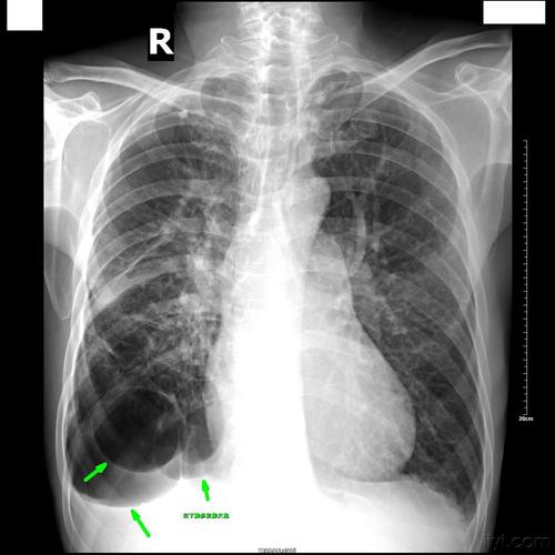 多例典型肺大泡的dr片,与大家分享!