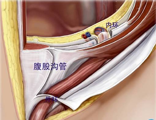 腹股沟区的解剖真性腹外疝的疝内容物必须位于由壁腹膜所组成的疝囊