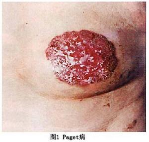 发生于单侧乳房及乳晕部表现为无痛性红色斑块常伴有湿疹化呈表浅糜烂