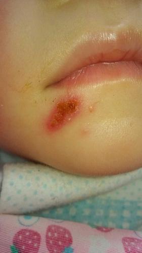 宝宝嘴角开始起了一个小红点,然后变水泡,水泡好像在传染其他地方