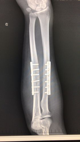 小儿尺桡骨骨折闭合复位弹性髓内针内固定