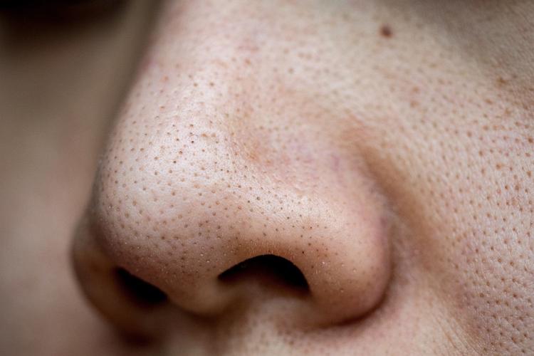 并经过氧化后变成黑色的小点附着在鼻子上面,从而形成草莓鼻