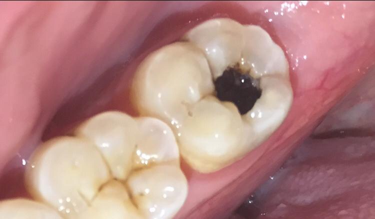 小孩的牙齿变黑是什么原因_郑州儿童龋齿|小孩坏牙|龋齿修复价格|龋齿