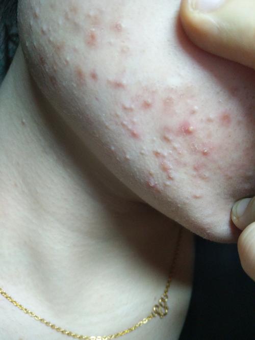 最近脸颊两侧长了很多小痘痘,不知道是闭口还是什么原因?